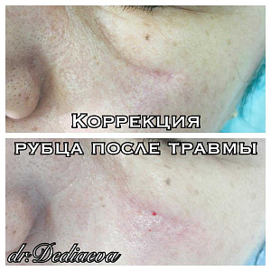 Коррекция рубца после травмы