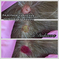 Лазерное удаление доброкачественных новообразований кожи