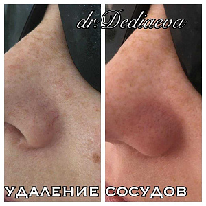 Удаление сосудов ComfoMed Studio Липецк