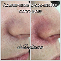Терапия сосудистых патологий и пигментаций кожи