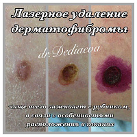 Лазерное удаление доброкачественных новообразований кожи
