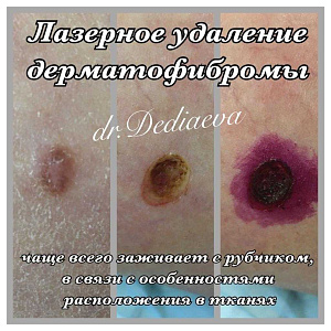 Лазерное удаление дерматофибромы
