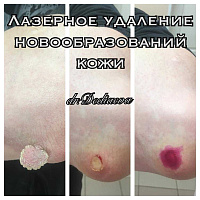 Лазерное удаление доброкачественных новообразований кожи
