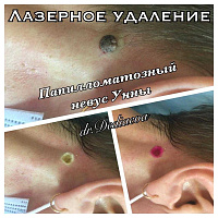 Лазерное удаление доброкачественных новообразований кожи