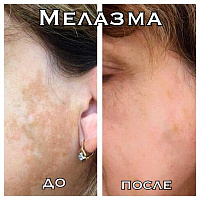 Терапия сосудистых патологий и пигментаций кожи