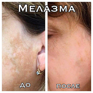 Мелазма