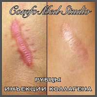 Лазерное лечение шрамов, рубцов (в т.ч. постакне), растяжек