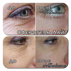 Сферогель лайт