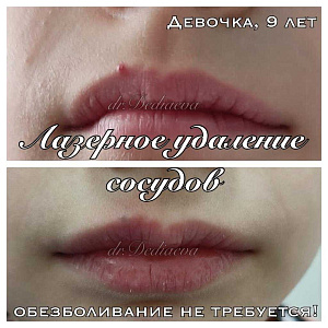 Удаление сосудов ComfoMed Studio Липецк