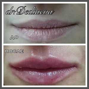 Контурная пластика губ