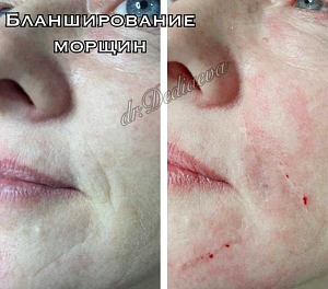 «Бланширование» морщин (контурная пластика)