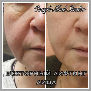 Векторный лифтинг лица