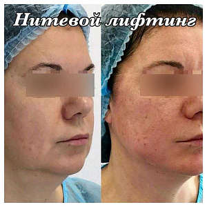 Нитевой лифтинг в Медикомф Липецк