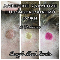 Лазерное удаление доброкачественных новообразований кожи