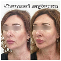 Тредлифтинг (нитевой лифтинг)