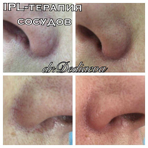 IPL-терапия сосудов