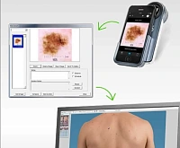 Цифровая дерматоскопия FotoFinder, Германия