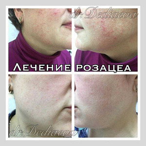 Удаление сосудов ComfoMed Studio Липецк