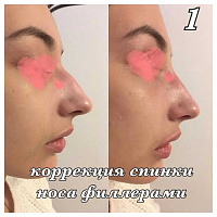 Контурная пластика лица