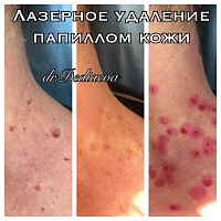 Лазерное удаление доброкачественных новообразований кожи