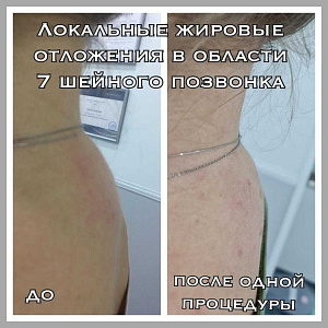 Локальные жировые отложения в области 7 шейного позвонка после 1 процедуры