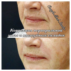 Коррекция зоны носогубных складок