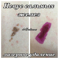 Лазерное удаление доброкачественных новообразований кожи