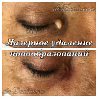 Лазерное удаление доброкачественных новообразований кожи