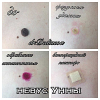 Лазерное удаление доброкачественных новообразований кожи