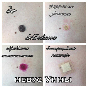 Лазерное удаление новообразований Липецк