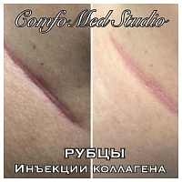 Лазерное лечение шрамов, рубцов (в т.ч. постакне), растяжек