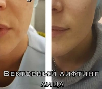 Контурная пластика лица