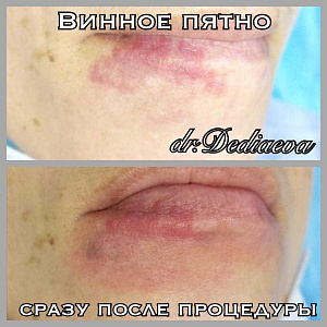 Винное пятно