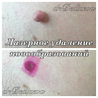 Лазерное удаление доброкачественных новообразований кожи