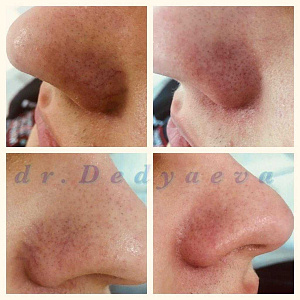 Лечение сосудистой патологии и пигментации