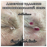 Лазерное удаление доброкачественных новообразований кожи