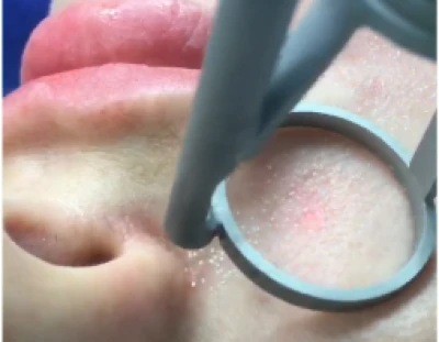 Лазерный пилинг