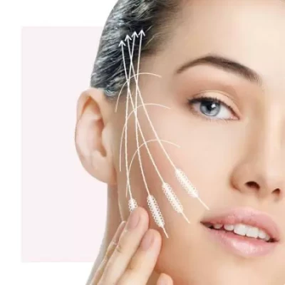 Тредлифтинг (нитевой лифтинг)